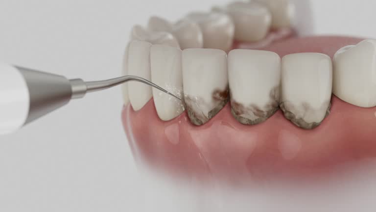 Trusted Wisdom Tooth Removal service in Ilchester, MD - Dentist Open Now